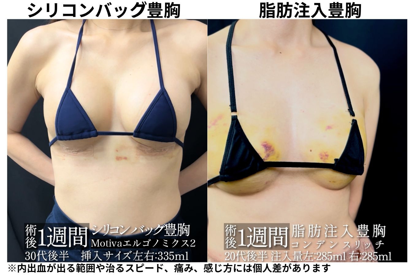 豊胸術の違いで痛みが変わる？