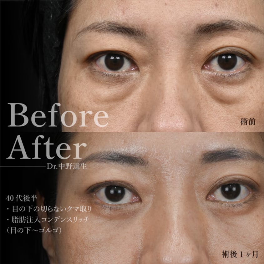 脱脂術 ― 原因である眼窩脂肪を取るシンプルな方法