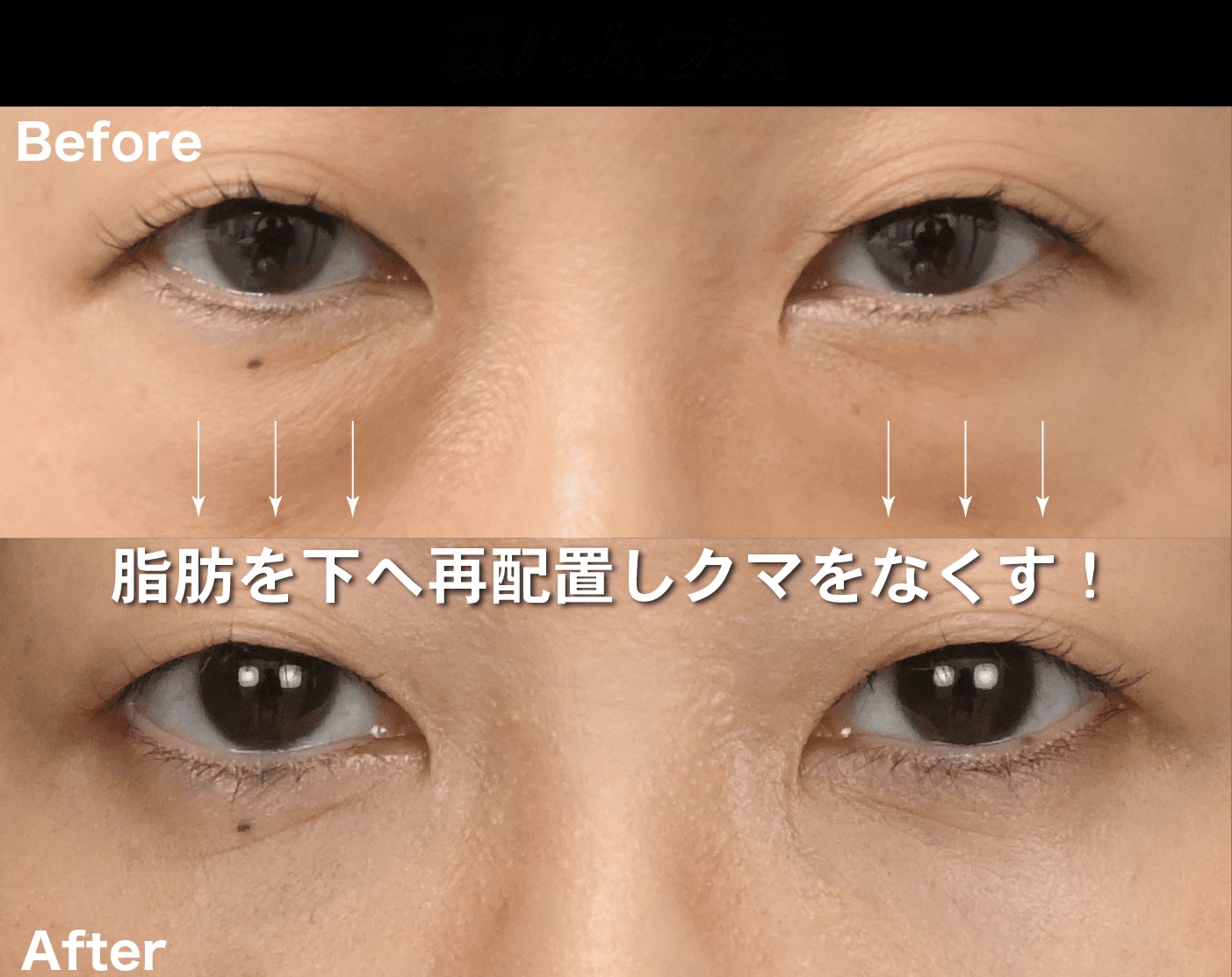 裏ハムラ法（経結膜ハムラ法）