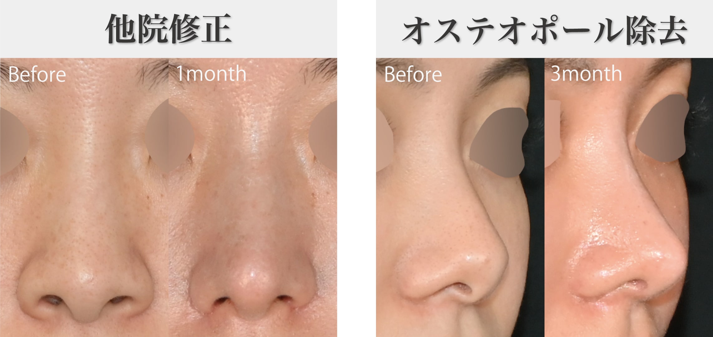 忘れ鼻に特化している