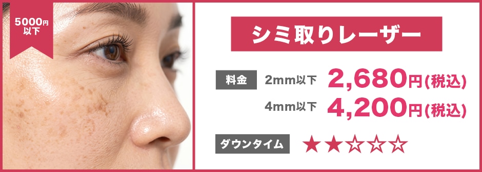 シミ取りレーザー