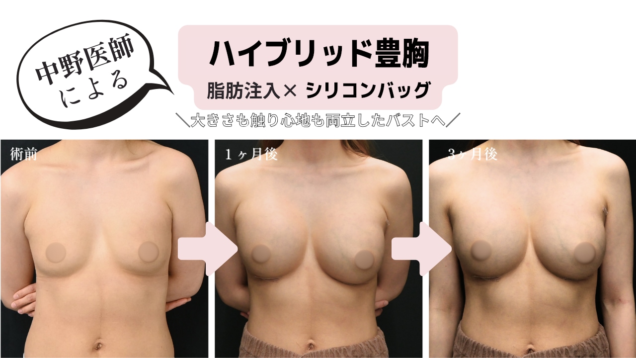 脂肪注入×シリコンバッグ豊胸「ハイブリッド」の症例を紹介！