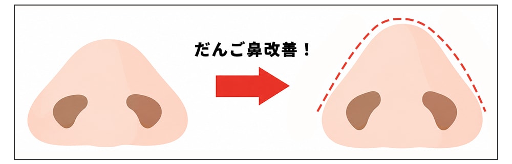 鼻尖形成って何？