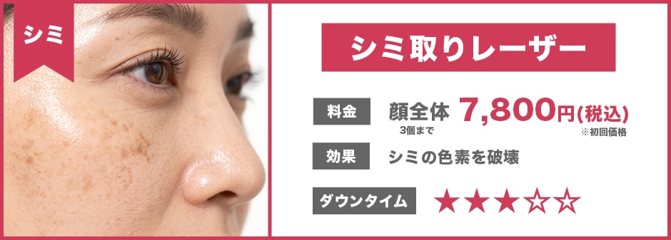 シミ取りレーザー