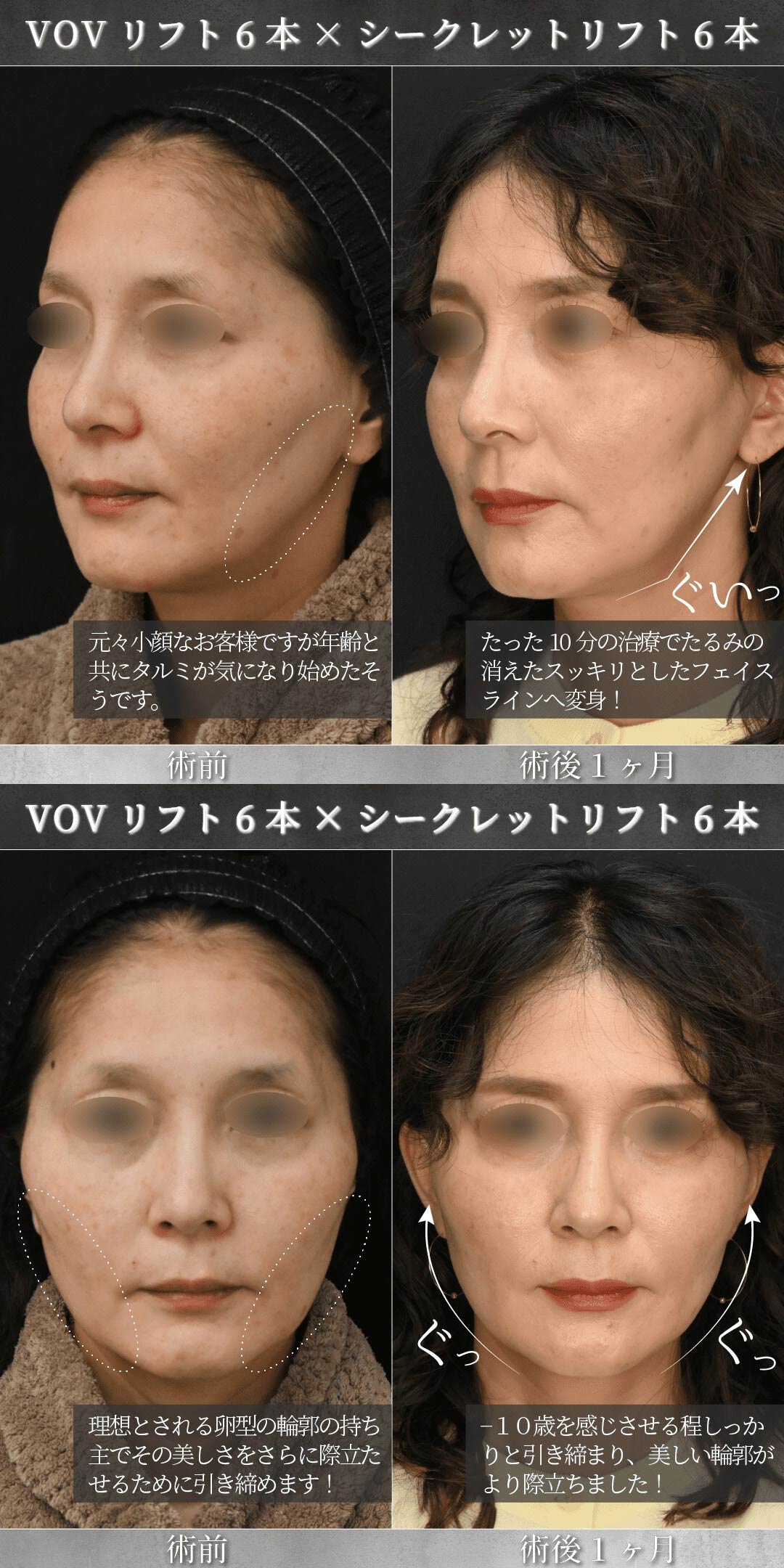 美しいフェイスラインを求める人必見