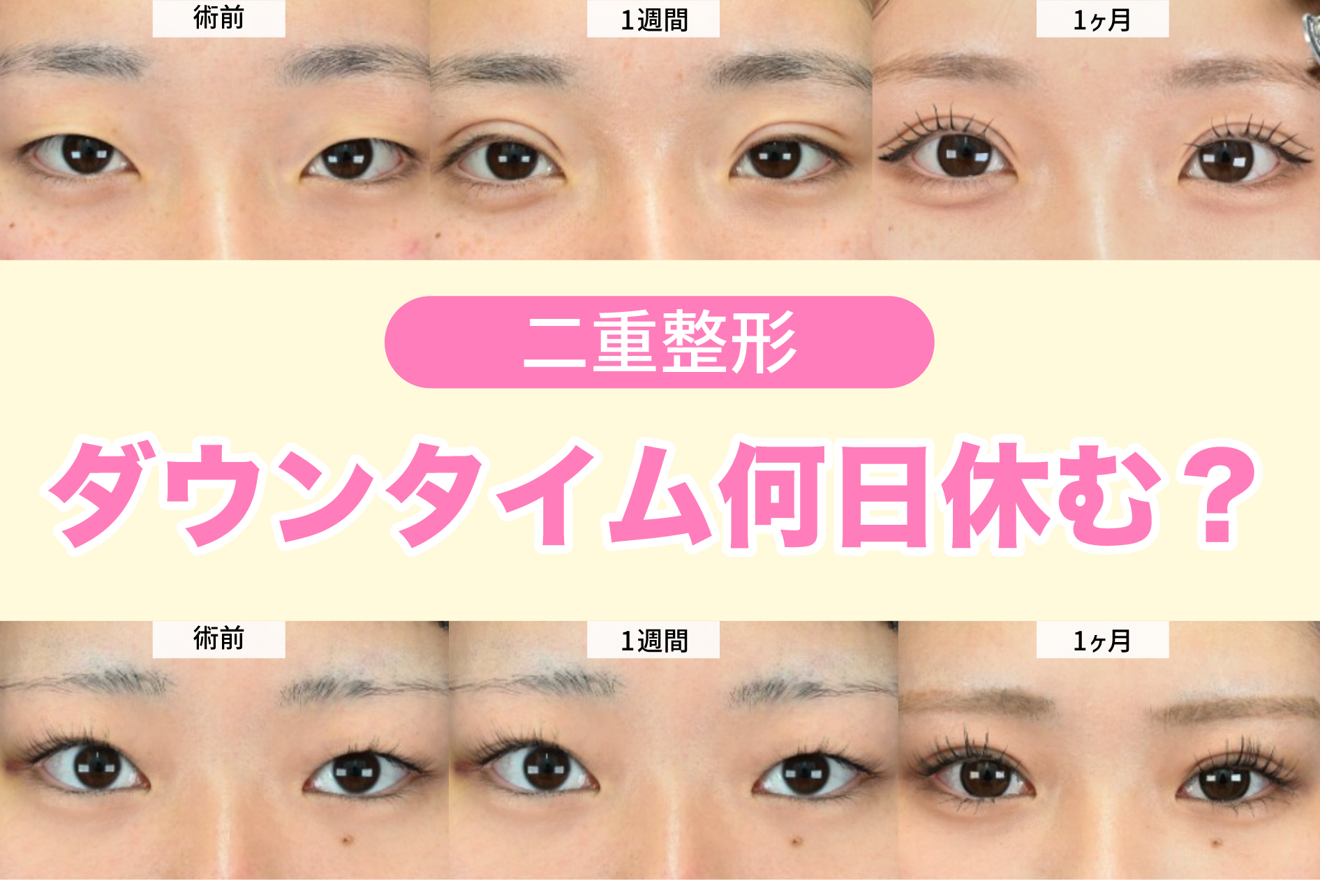 【二重整形は何日休む？】年末年始がおすすめな理由｜埋没・切開のダウンタイムを解説