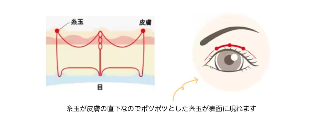 【フォーエバー二重術】<br />
糸の結び方、糸の通し方を根本から改革し、一重に戻りにくくなるよう開発した埋没法