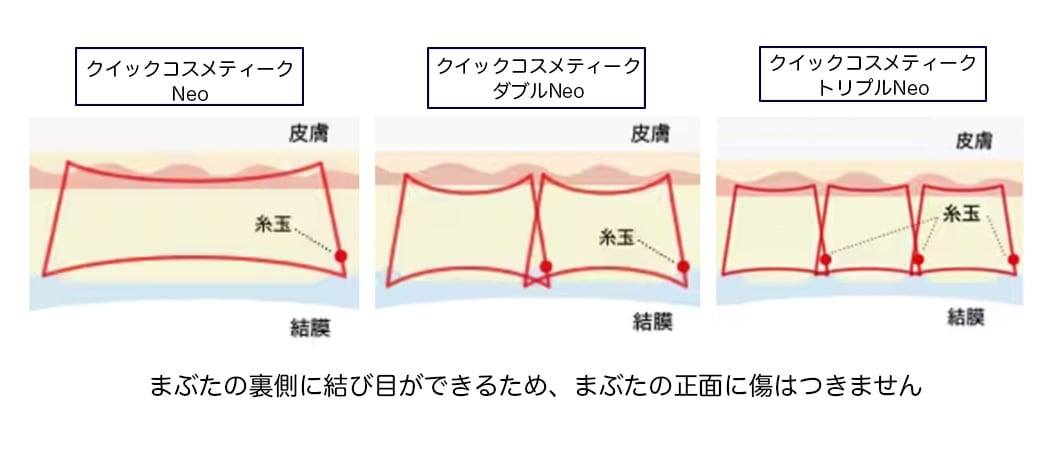 【クイックコスメティーク法】<br />
特許を取得した特殊な技法により、目をつぶったときに糸の結び目が目立ちにくい