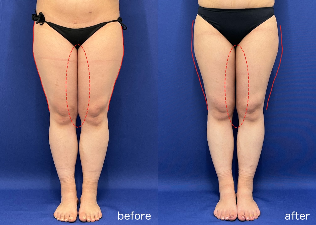 下半身の脂肪吸引の症例：臀部・太もも・膝