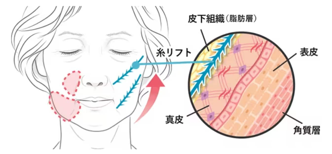 ①下垂脂肪を直接持ち上げ、美しい位置に脂肪を再配置