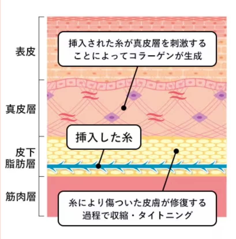 ②今の引き上げだけじゃない！糸リフトなら、未来のたるみも作らない。