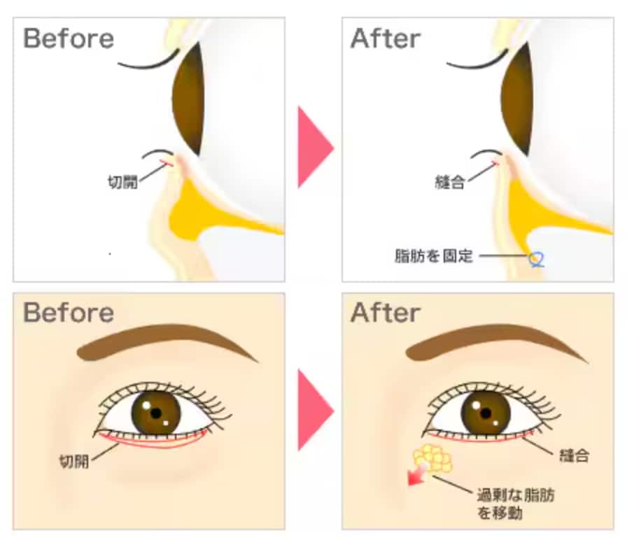 切開ハムラ法(表ハムラ法)