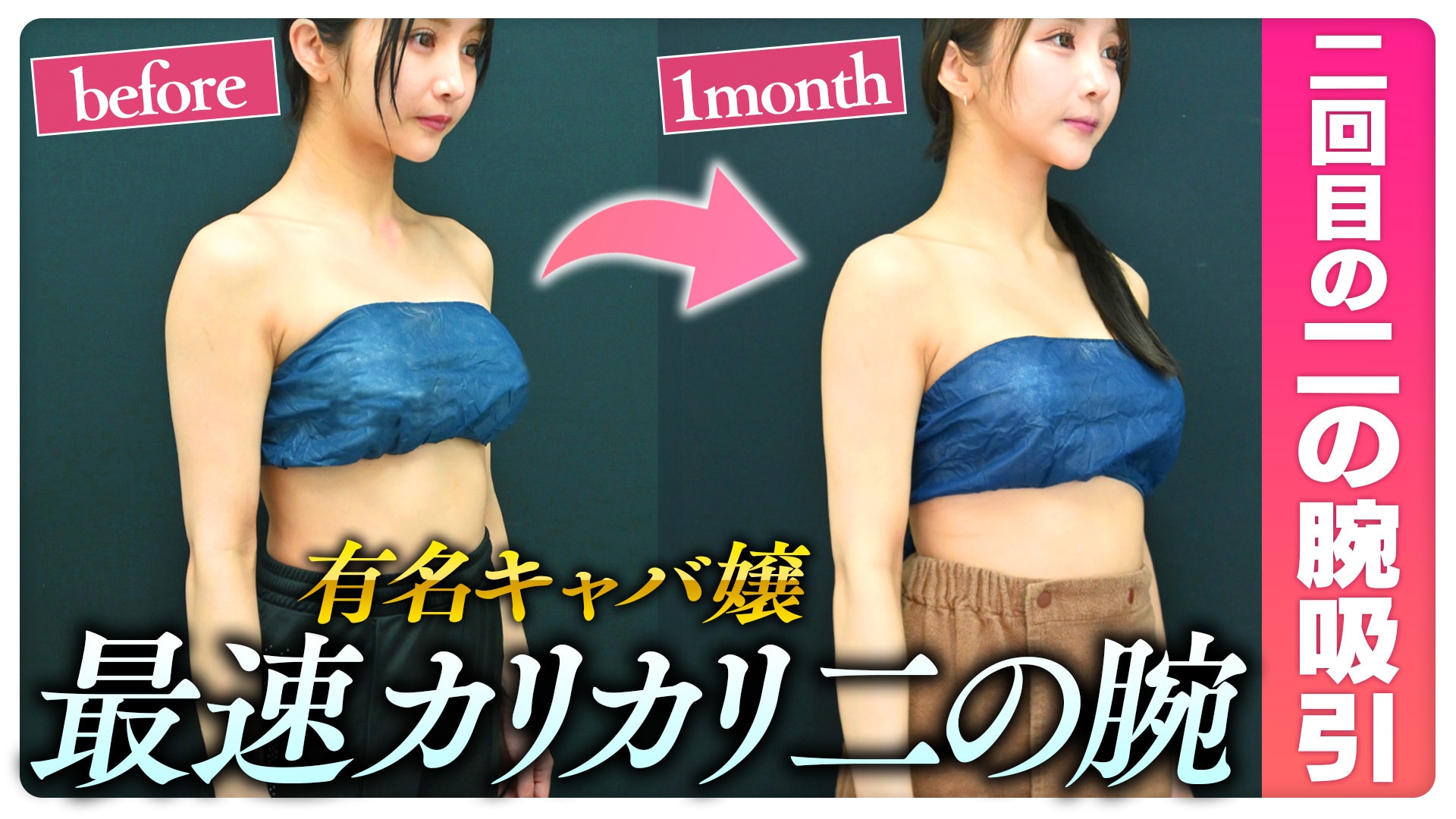 二の腕痩せ】有名キャバ嬢えれちゃん密着！2回目の二の腕脂肪吸引をし 