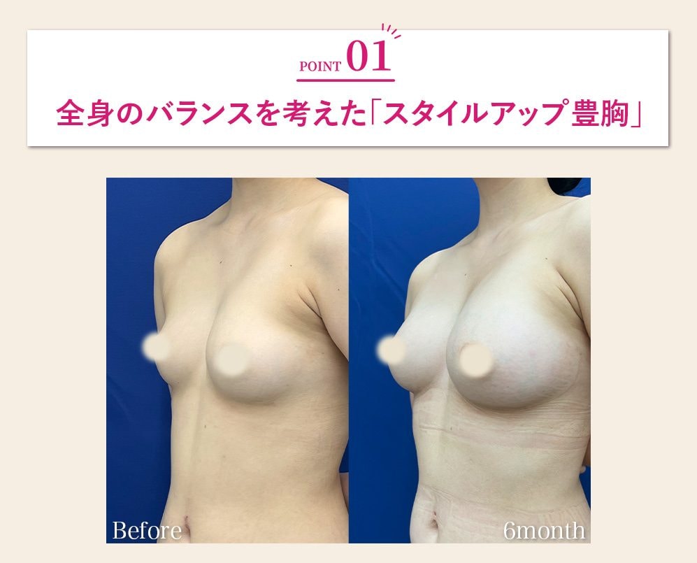 全身のバランスを考えた「スタイルアップ豊胸」