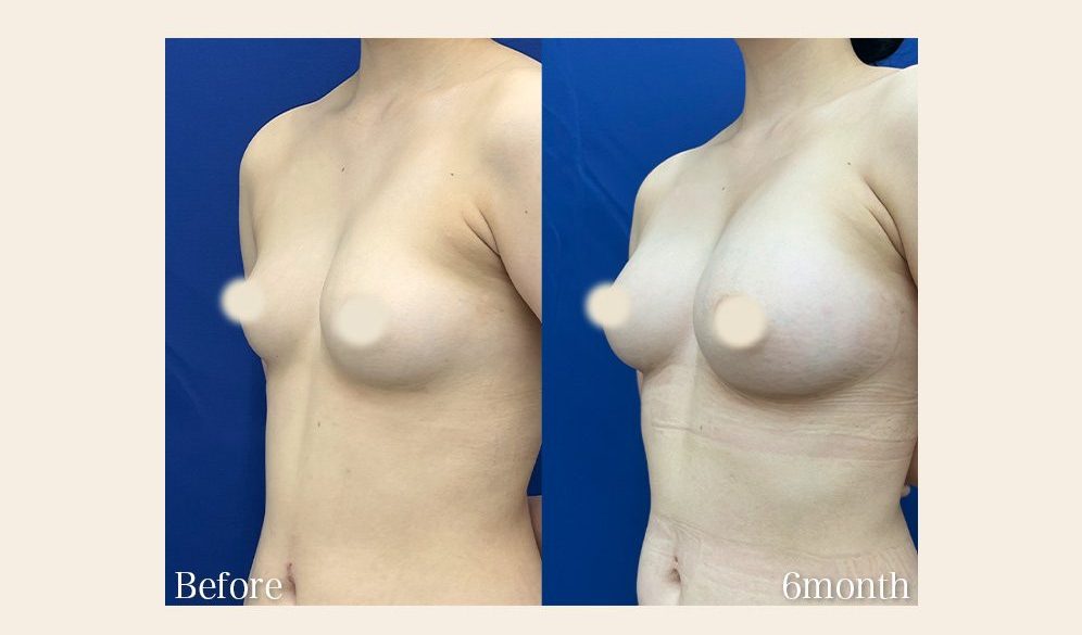 全身のバランスを考えた「スタイルアップ豊胸」