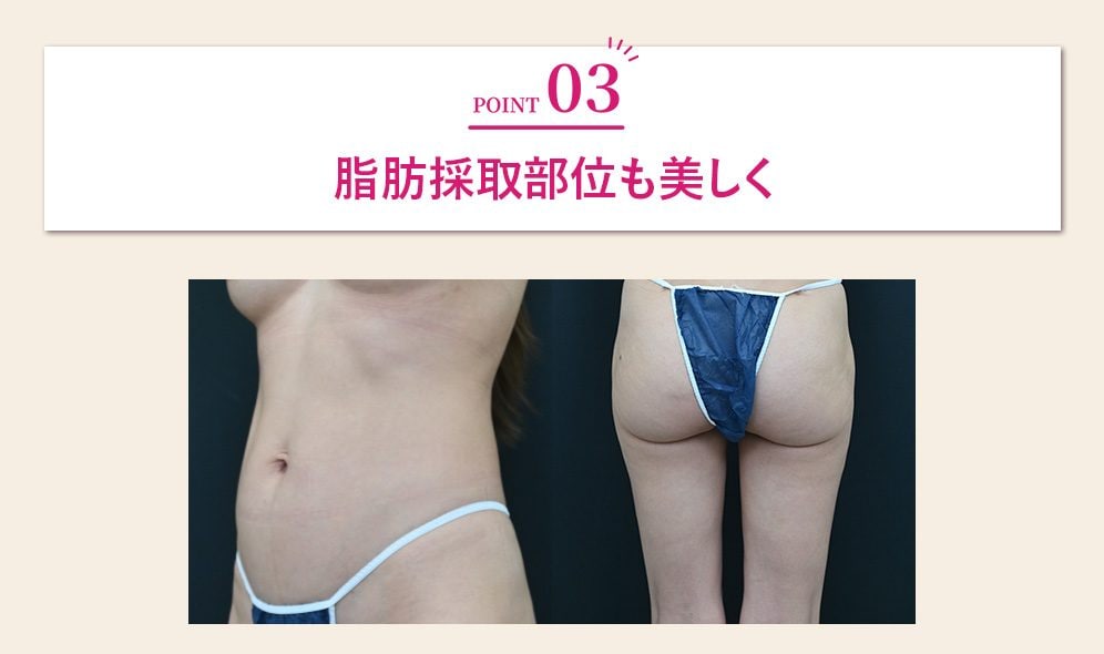 脂肪採取部位も美しく
