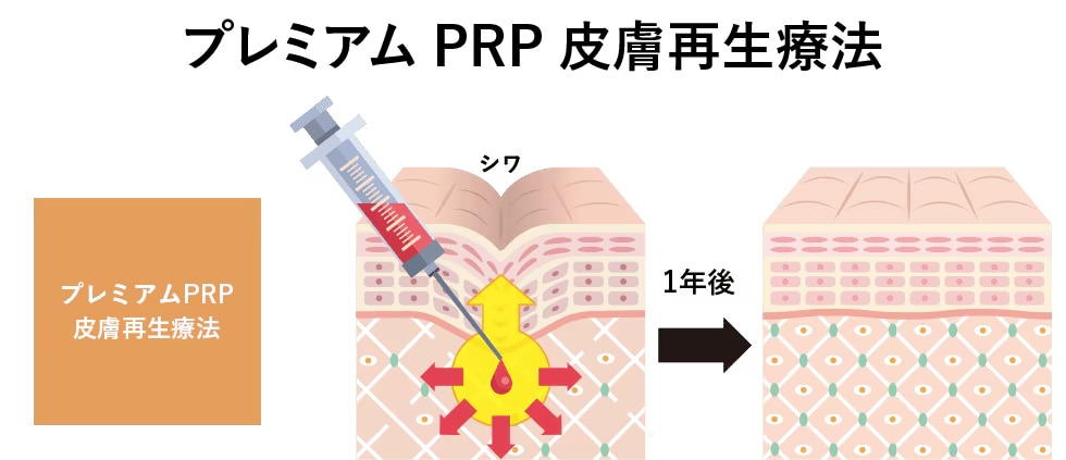 SBCプレミアムPRP皮膚再生療法