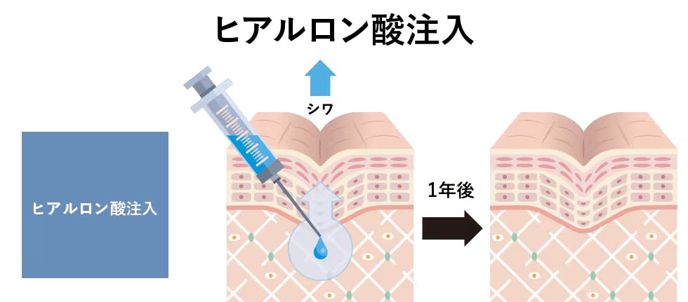 ヒアルロン酸注入