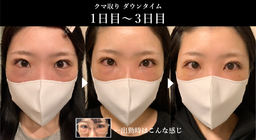 ダウンタイム中は、以下の点に注意して過ごしましょう