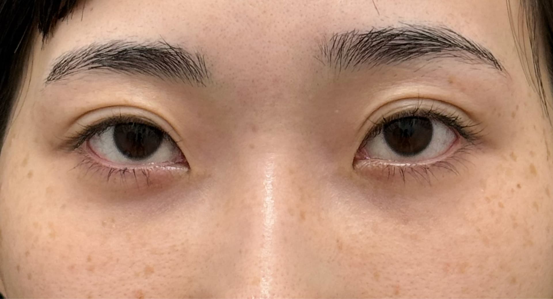 【中部地区で裏ハムラ法できる女医は数名！】<br />
美的センスが光る女医のクマ取り