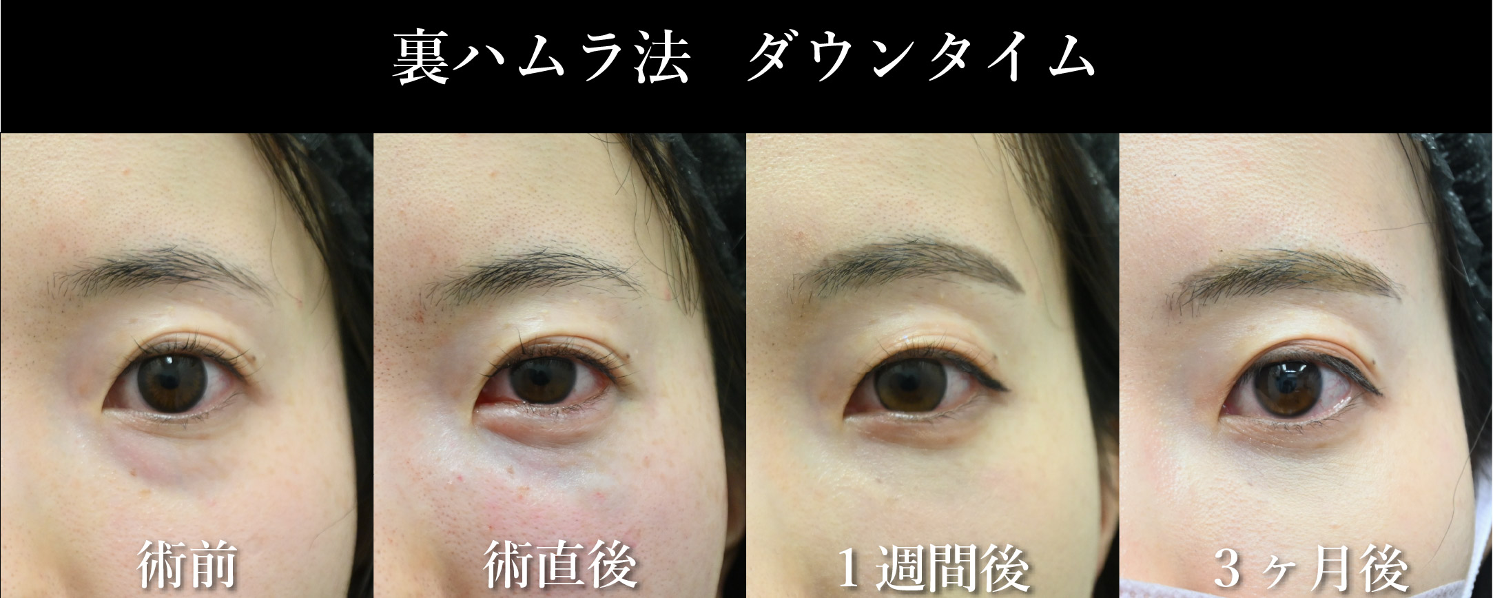 ダウンタイムはどのくらいですか？
