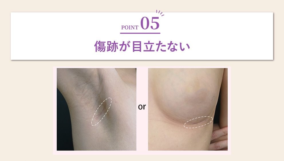 傷跡が目立たない