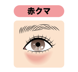 赤クマの原因
