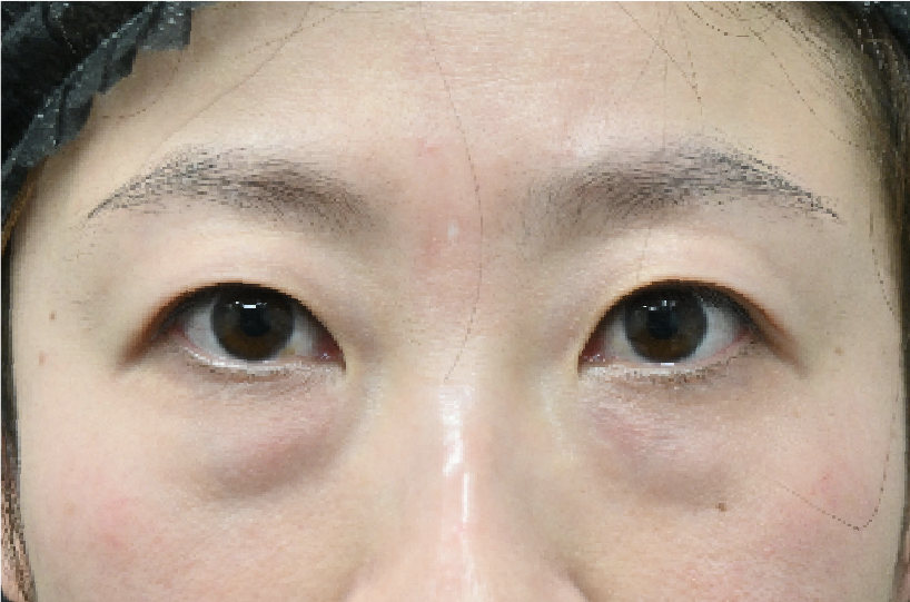 クマ、たるみを改善★
