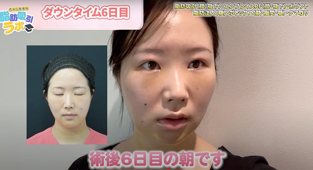 ダウンタイム6日目の朝