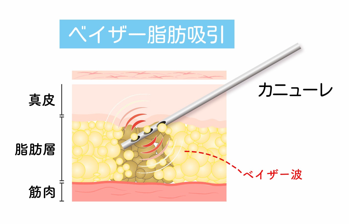 ベイザー脂肪吸引