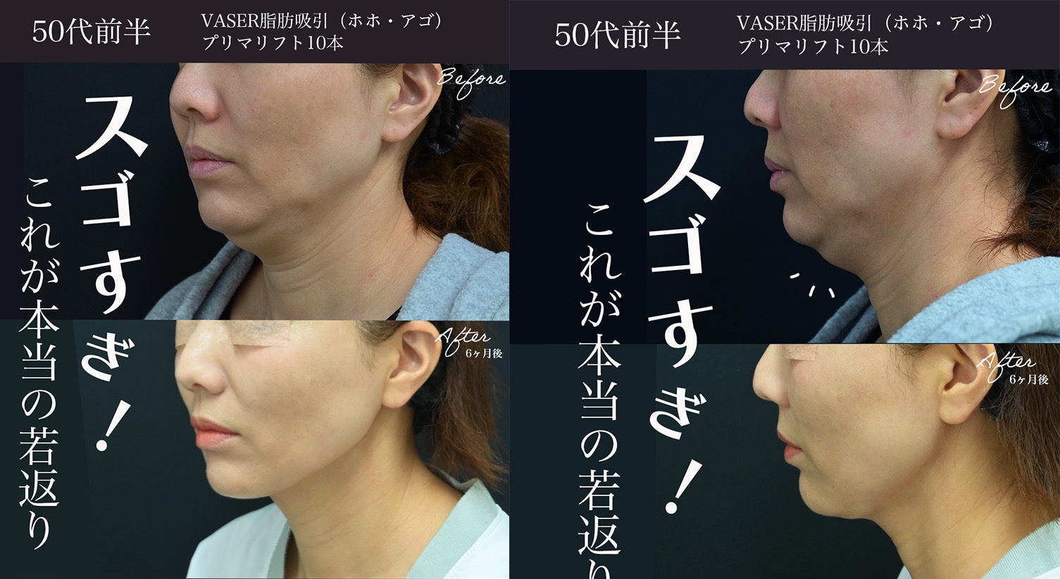 山本高士医師執刀：顔の脂肪吸引の症例写真
