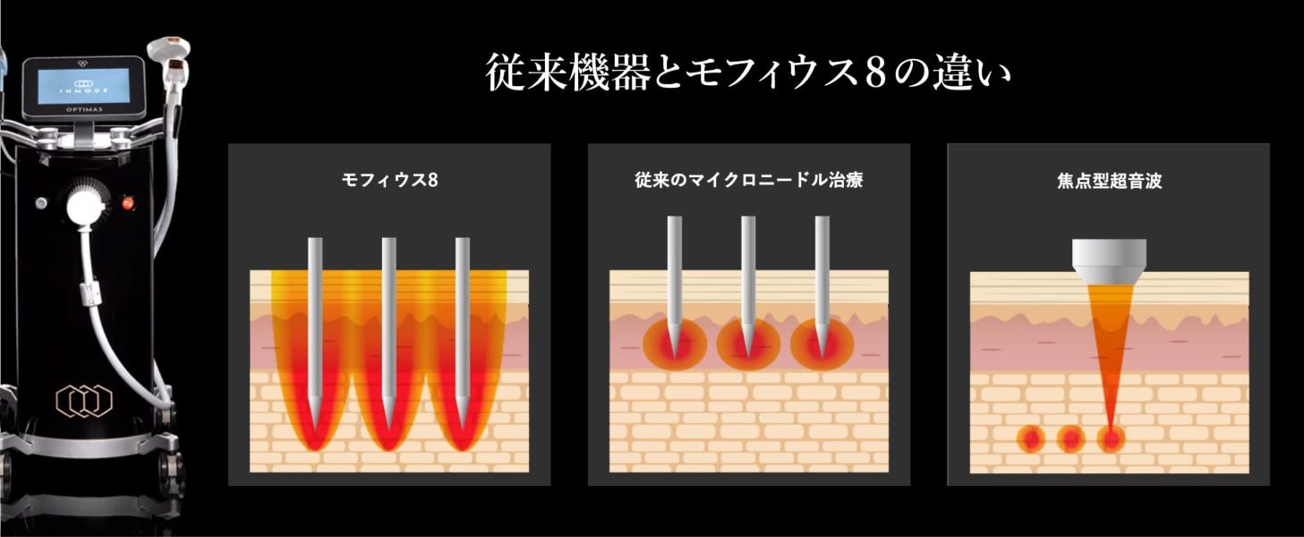 高周波(RF)だけで叶えるクマ治療