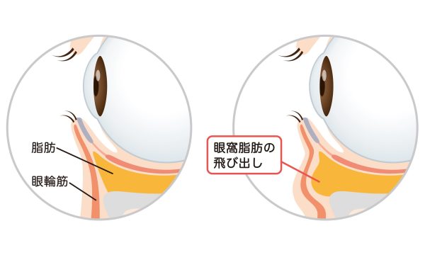 疲れ顔に見せる「クマ」の正体