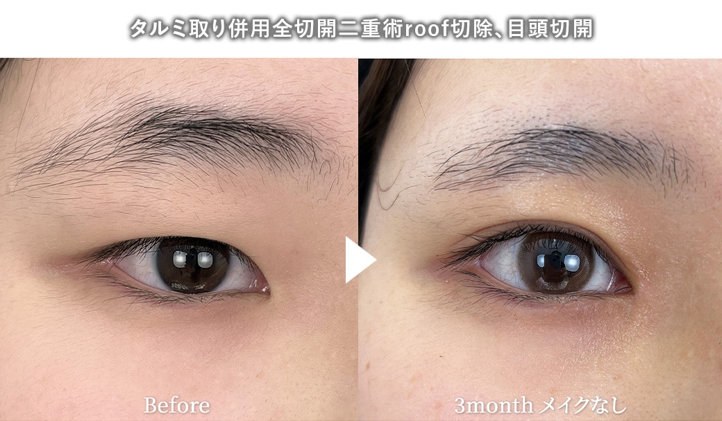 全切開二重術