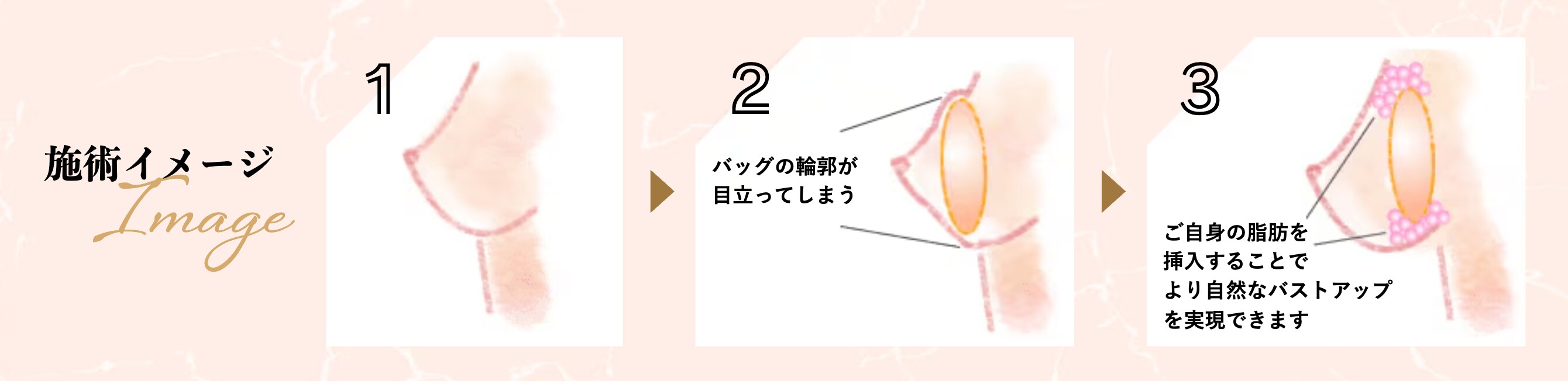 脂肪注入との併用も可能<br />
