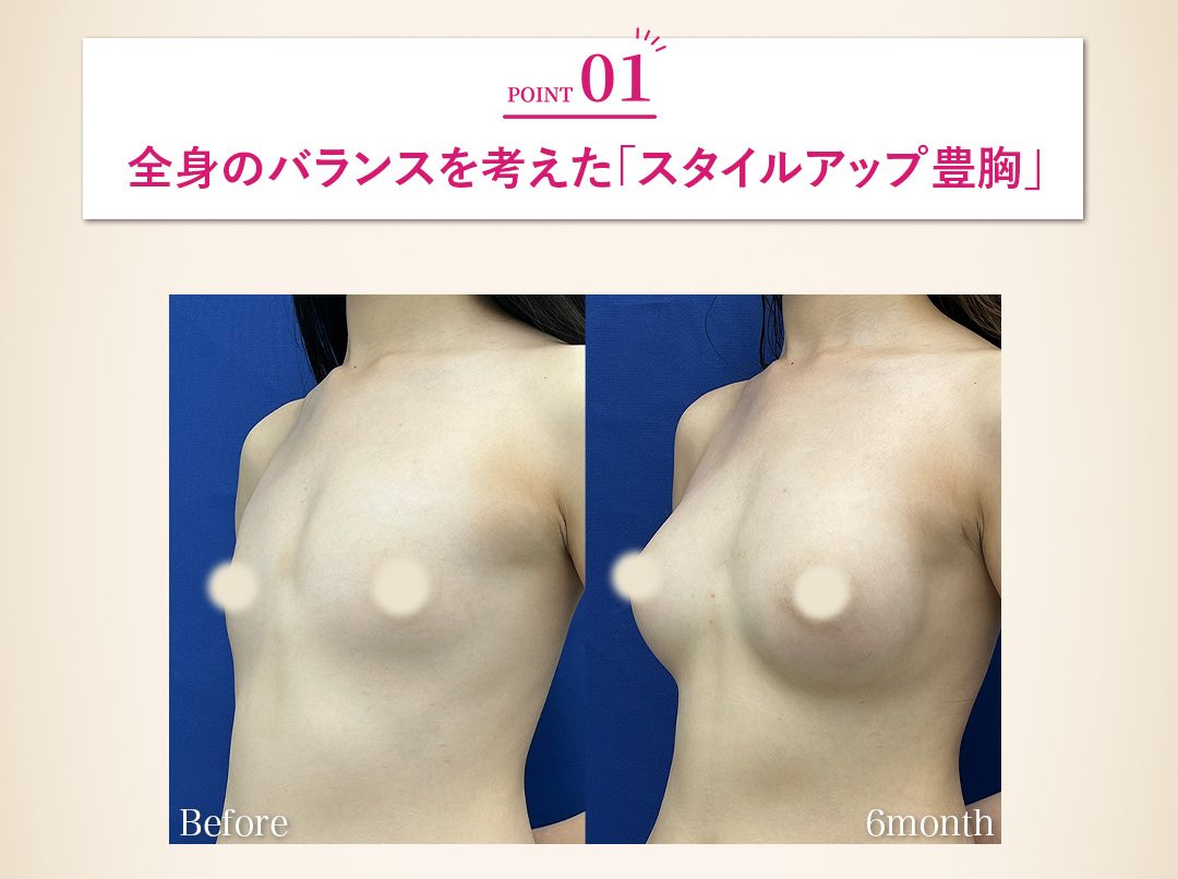 全身のバランスを考えた「スタイルアップ豊胸」