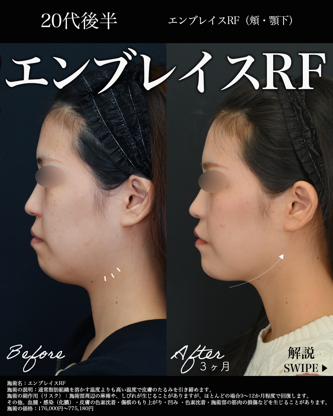 【施術内容】エンブレイスRF（ホホ・アゴ下）