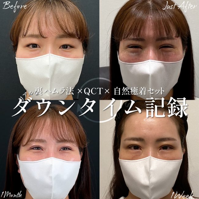 【写真で見る】術後から完成までのダウンタイム経過モデル