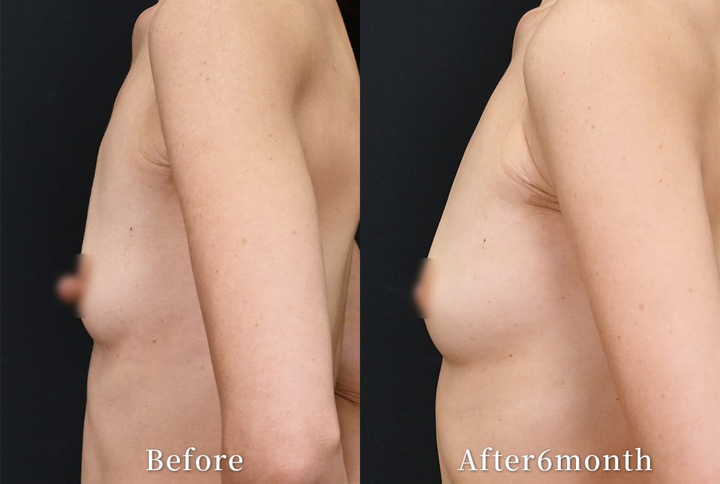 乳頭縮小、コンデンスリッチ脂肪注入豊胸