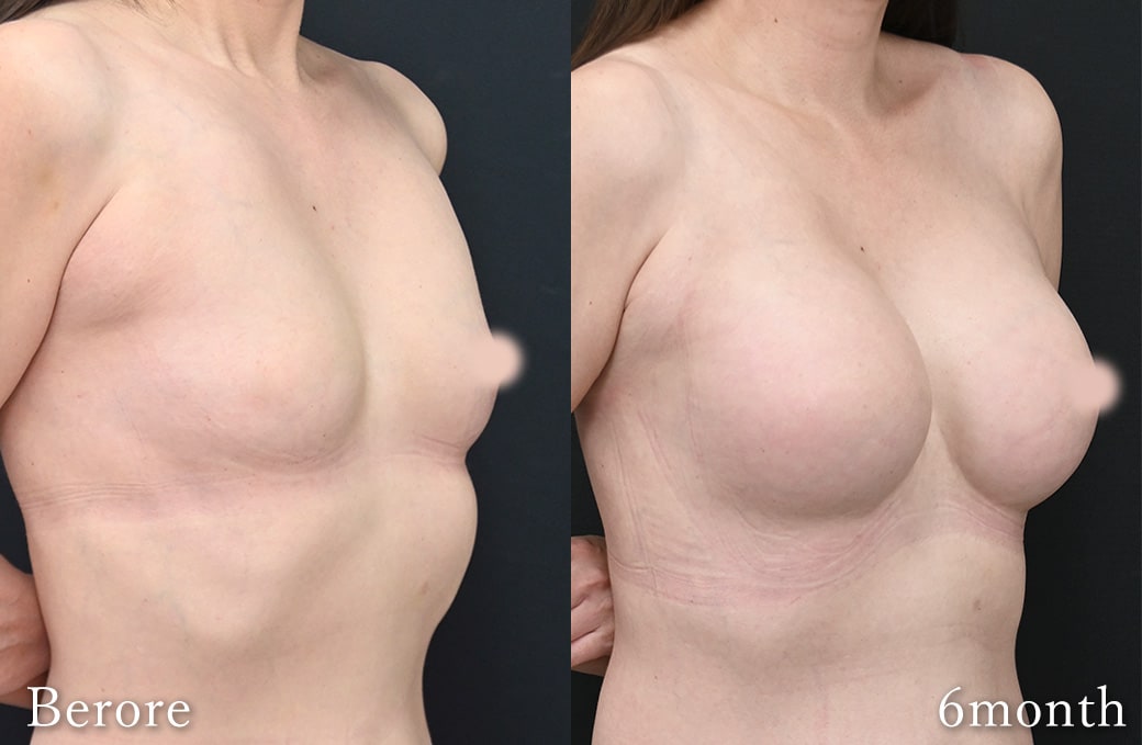 全身のバランスを考えた「スタイルアップ豊胸」