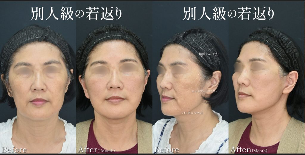 山本高士医師_スマスフェイスリフト_症例