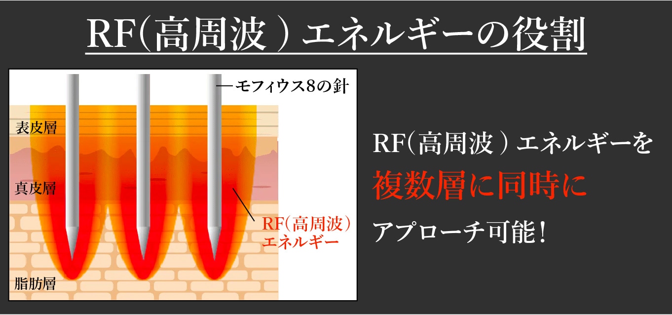 RF（高周波）エネルギーの照射