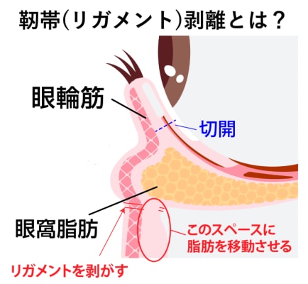 「靭帯(リガメント)を剥がす」とは? なぜ重要なのか?
