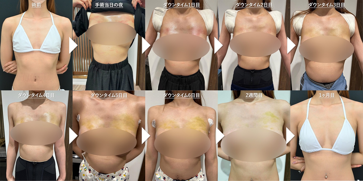ダウンタイムの期間と主な症状