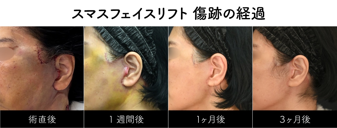 Q. 傷跡は目立ちますか？