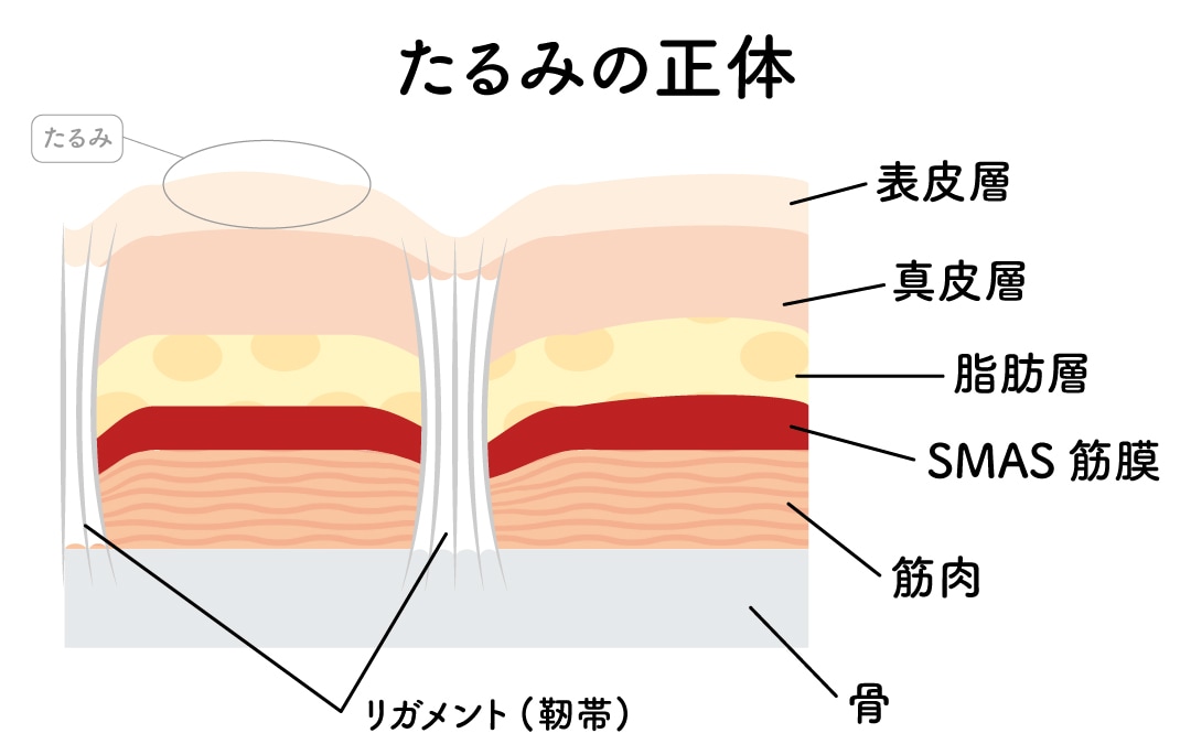 事前に知っておきたい「たるみ」の正体