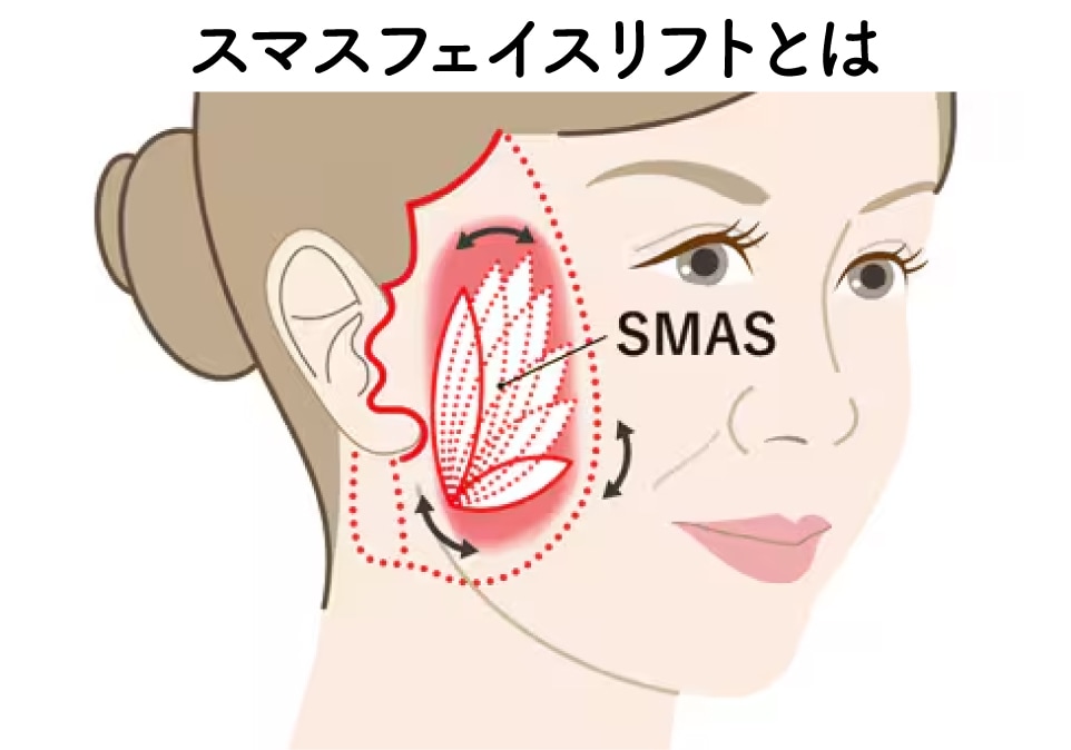 たるみの土台「SMAS筋膜」から引き上げる本格若返り術