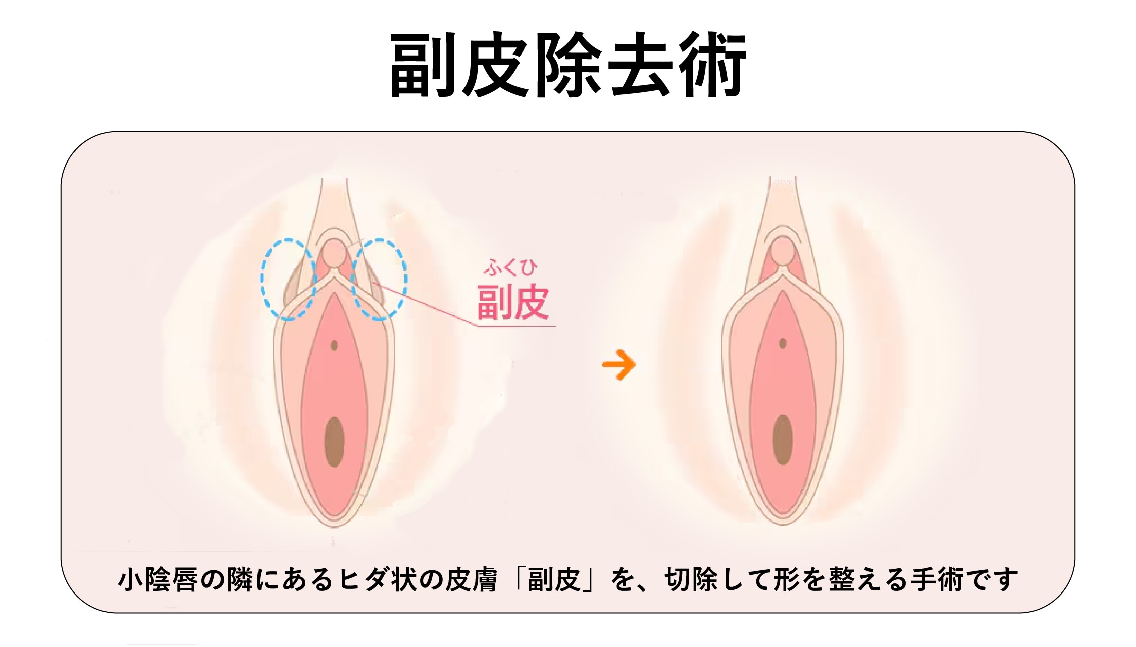 副皮除去術<br />