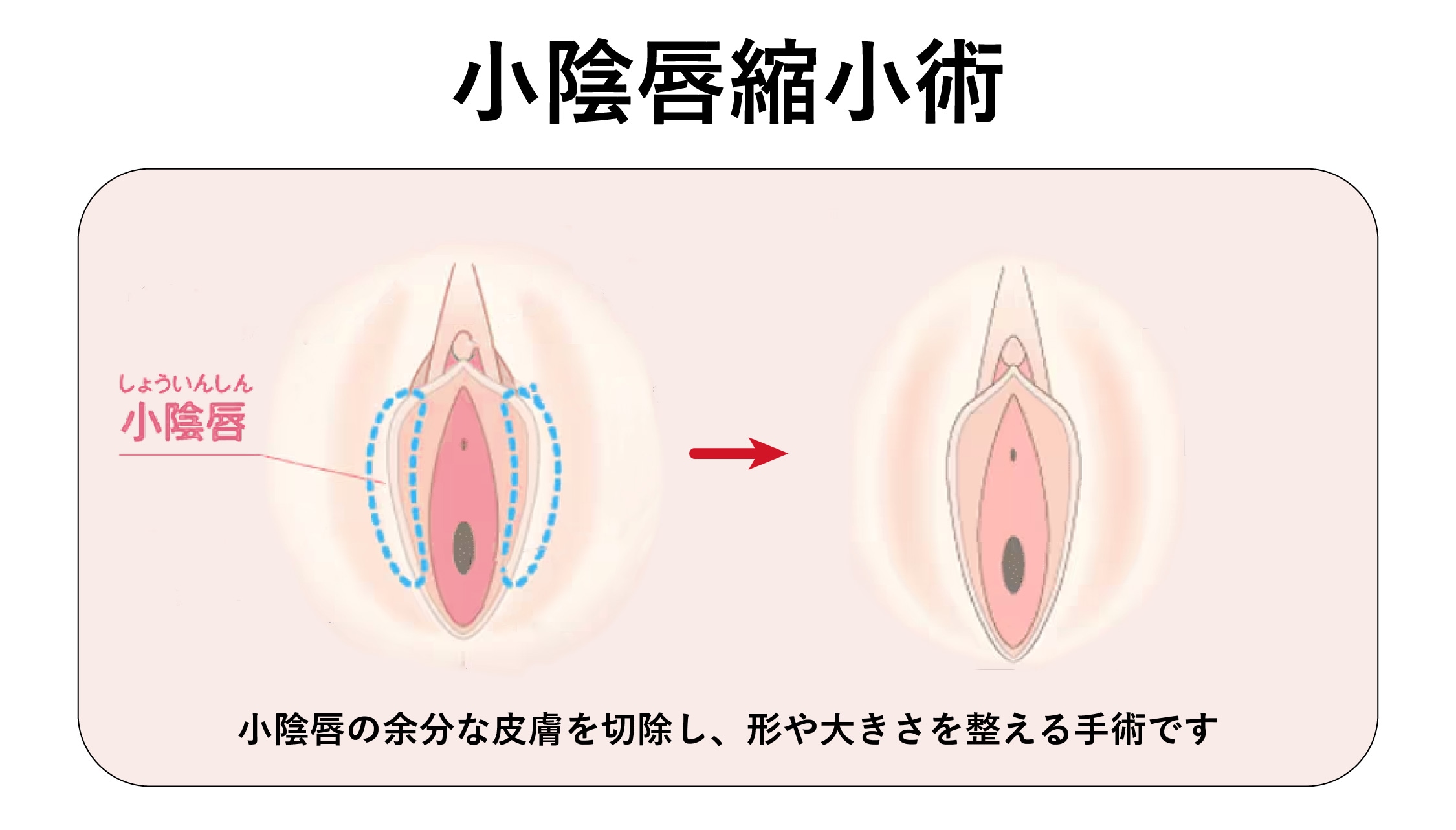 小陰唇縮小術<br />