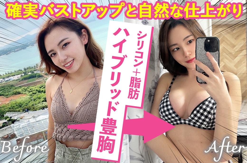 ハイブリッド豊胸するなら【豊胸の名医】山本高士医師がおすすめ【湘南美容クリニック名古屋院】